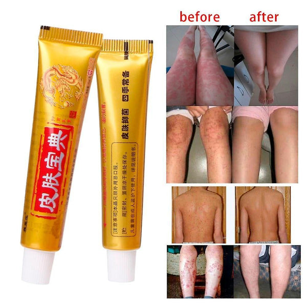 new anti bacteria herbal cream psoriasis eczema ointment sm1657