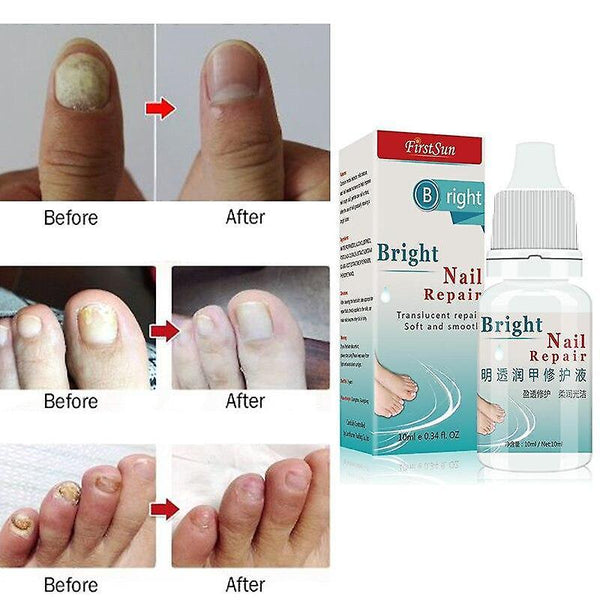 Nail Fungus Treatment Nails Repair Liqui SM56060